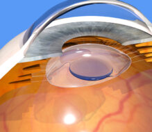 The Advantages Of Eye Lens Implants