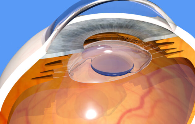The Advantages Of Eye Lens Implants